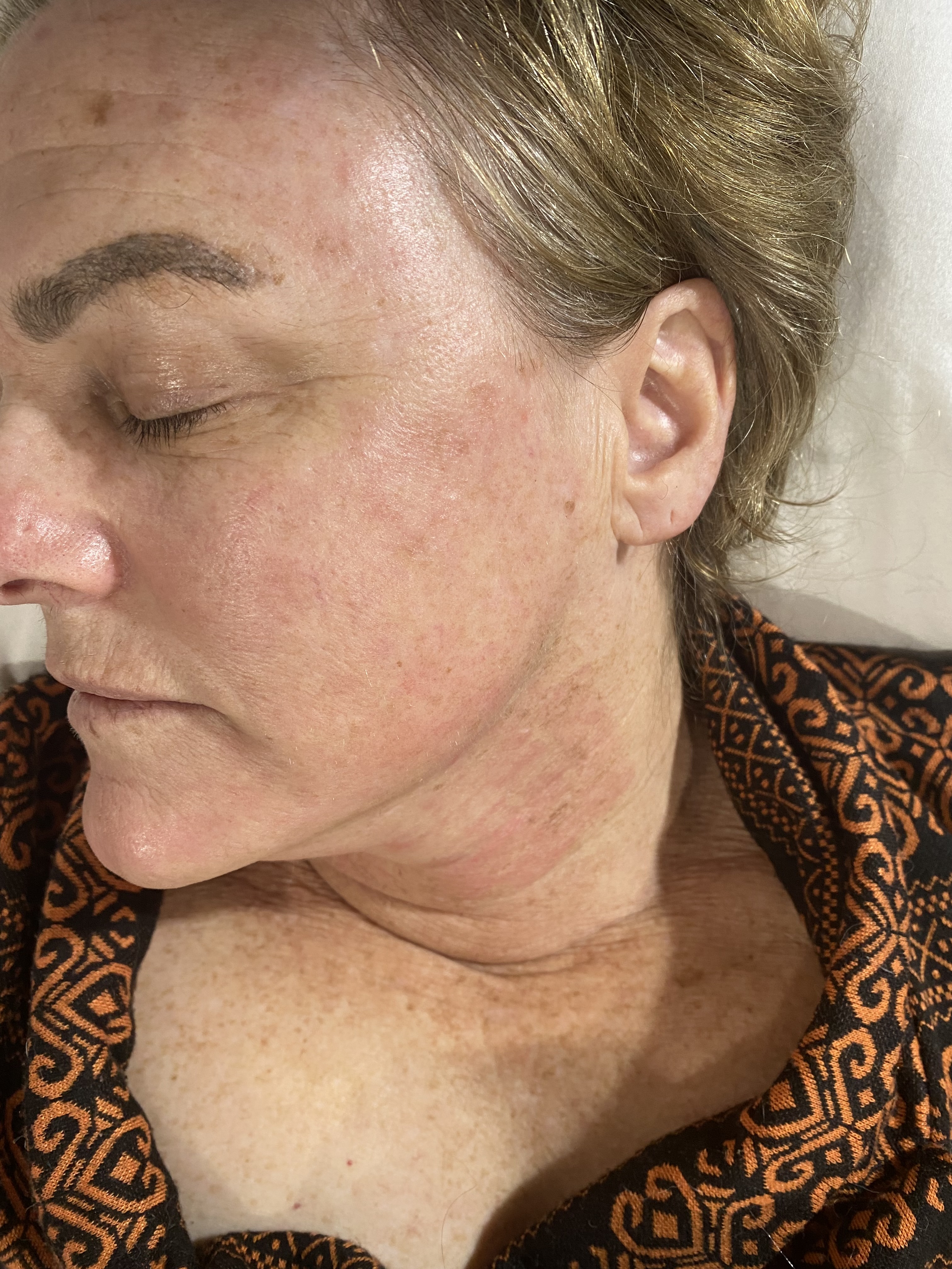 CO2 Laser Resurfacing Before
